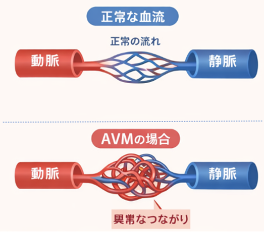脳動静脈奇形（AVM）01