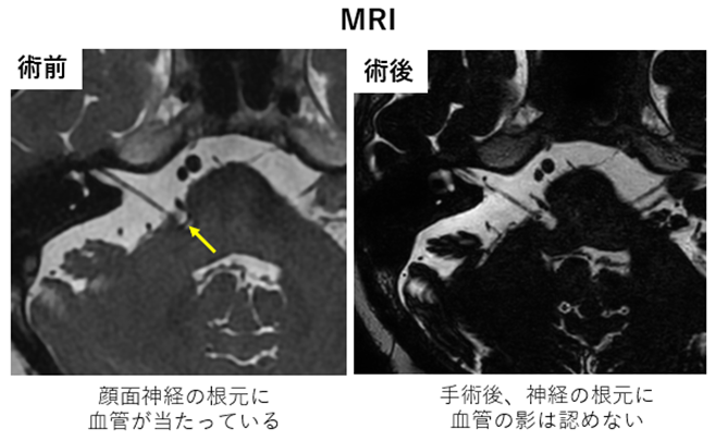 MRI
