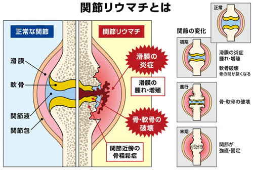 関節リウマチについて