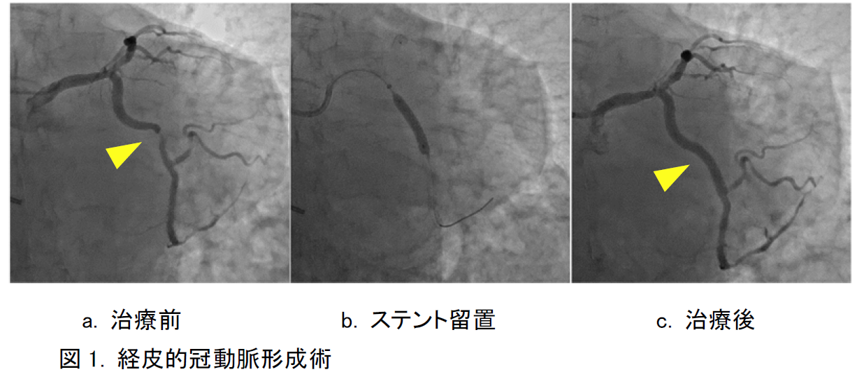 経皮的冠動脈形成術