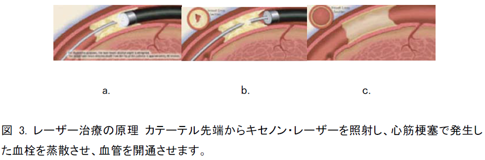 レーザー治療の原理