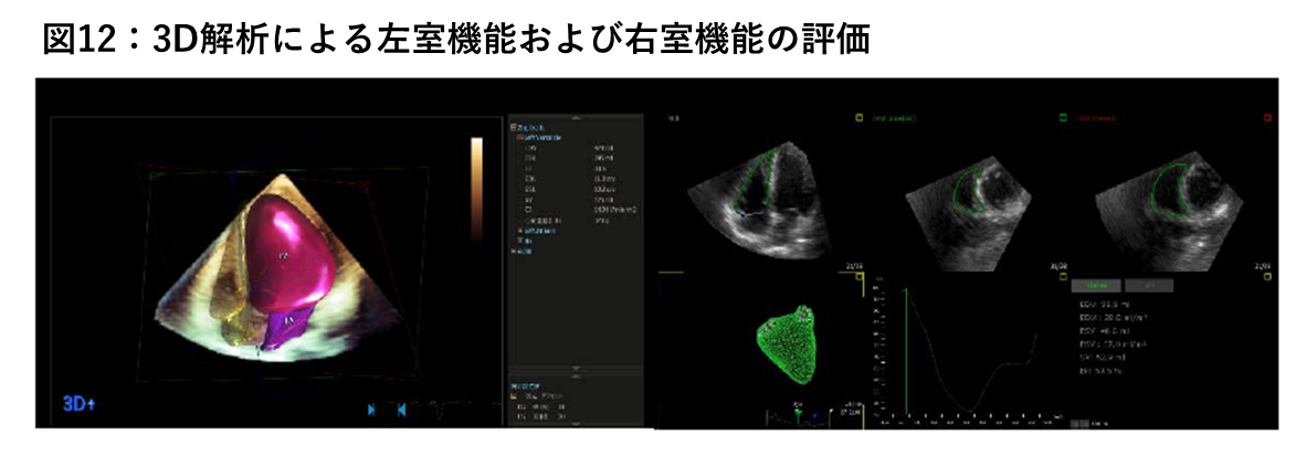 3D解析による左室機能および右室機能の評価