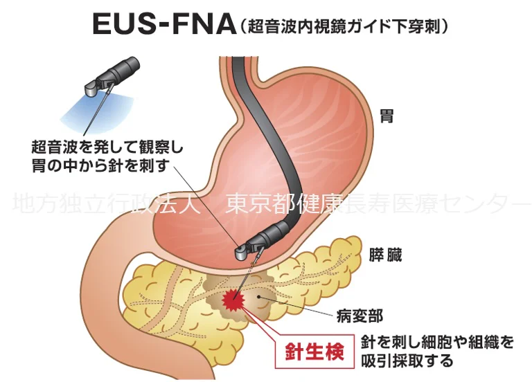 超音波内視鏡下穿刺術（EUS-FNA）