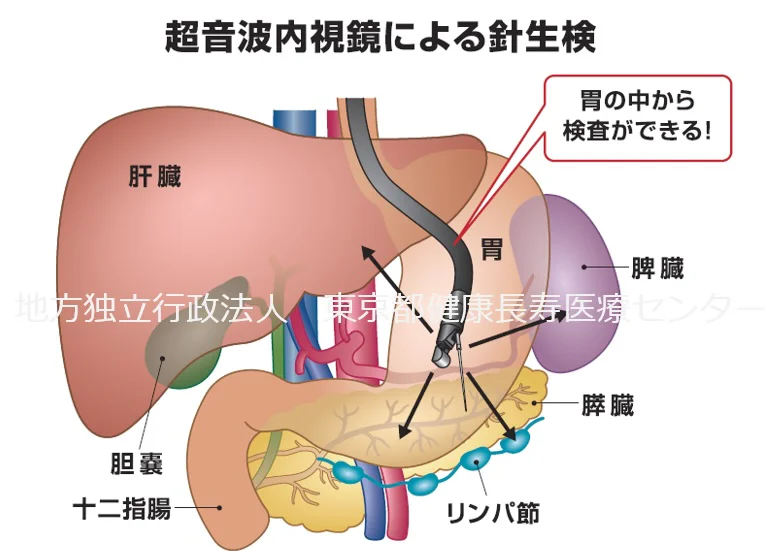 超音波内視鏡による針生検