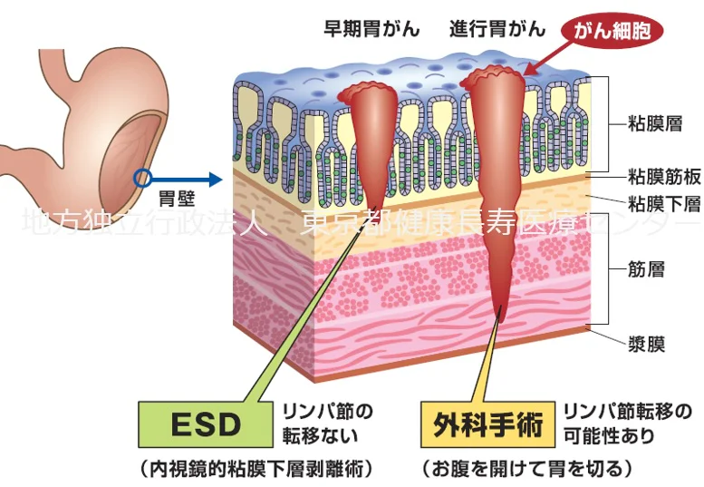 内視鏡的粘膜下層剥離術（ESD）