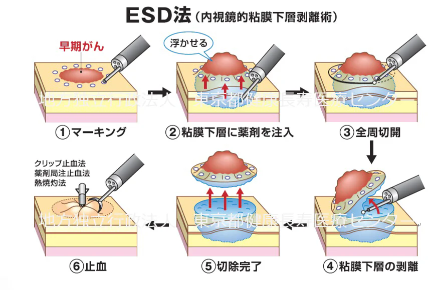 ESD法