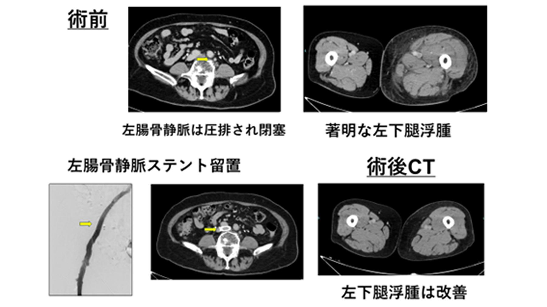 下肢静脈血栓症