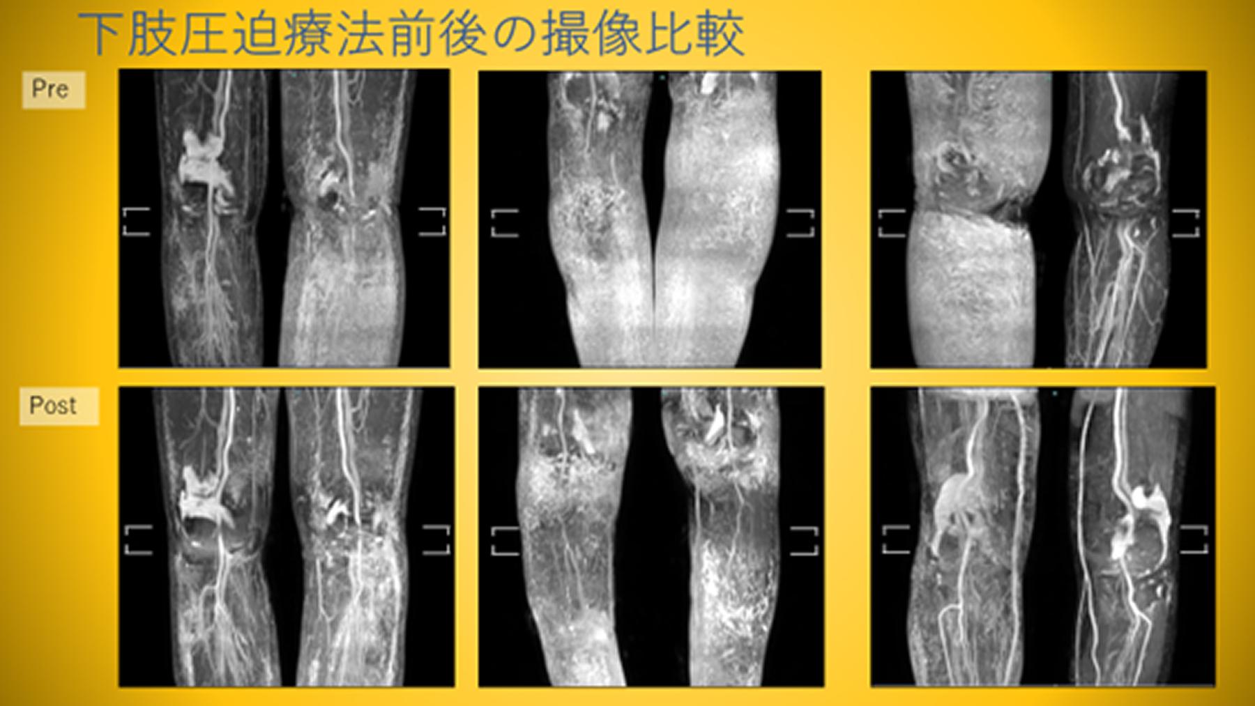 下腿浮腫