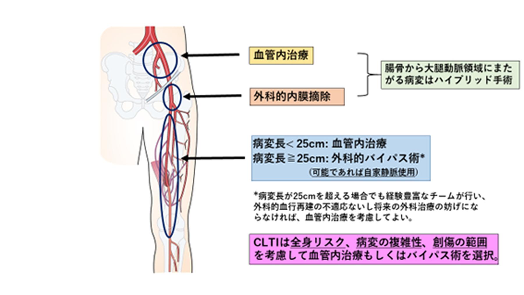 大動脈瘤