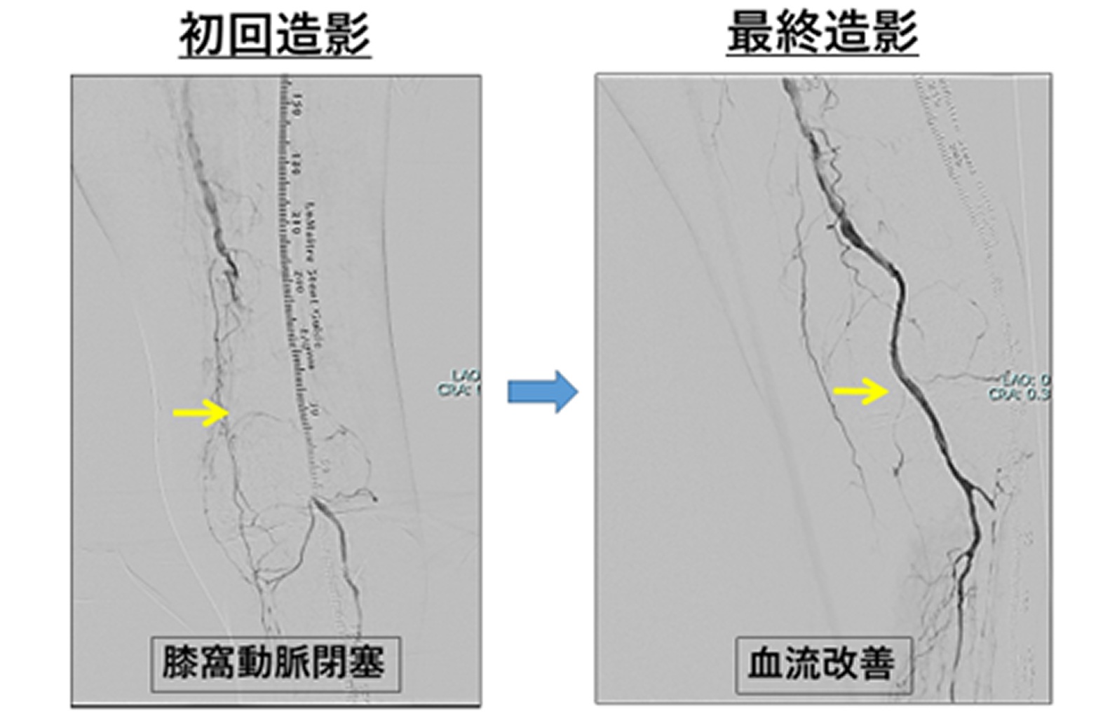 下肢急性動脈閉塞