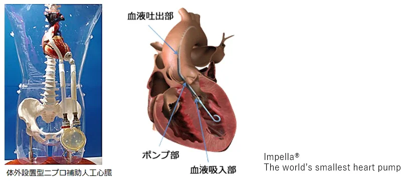 補助人工心臓