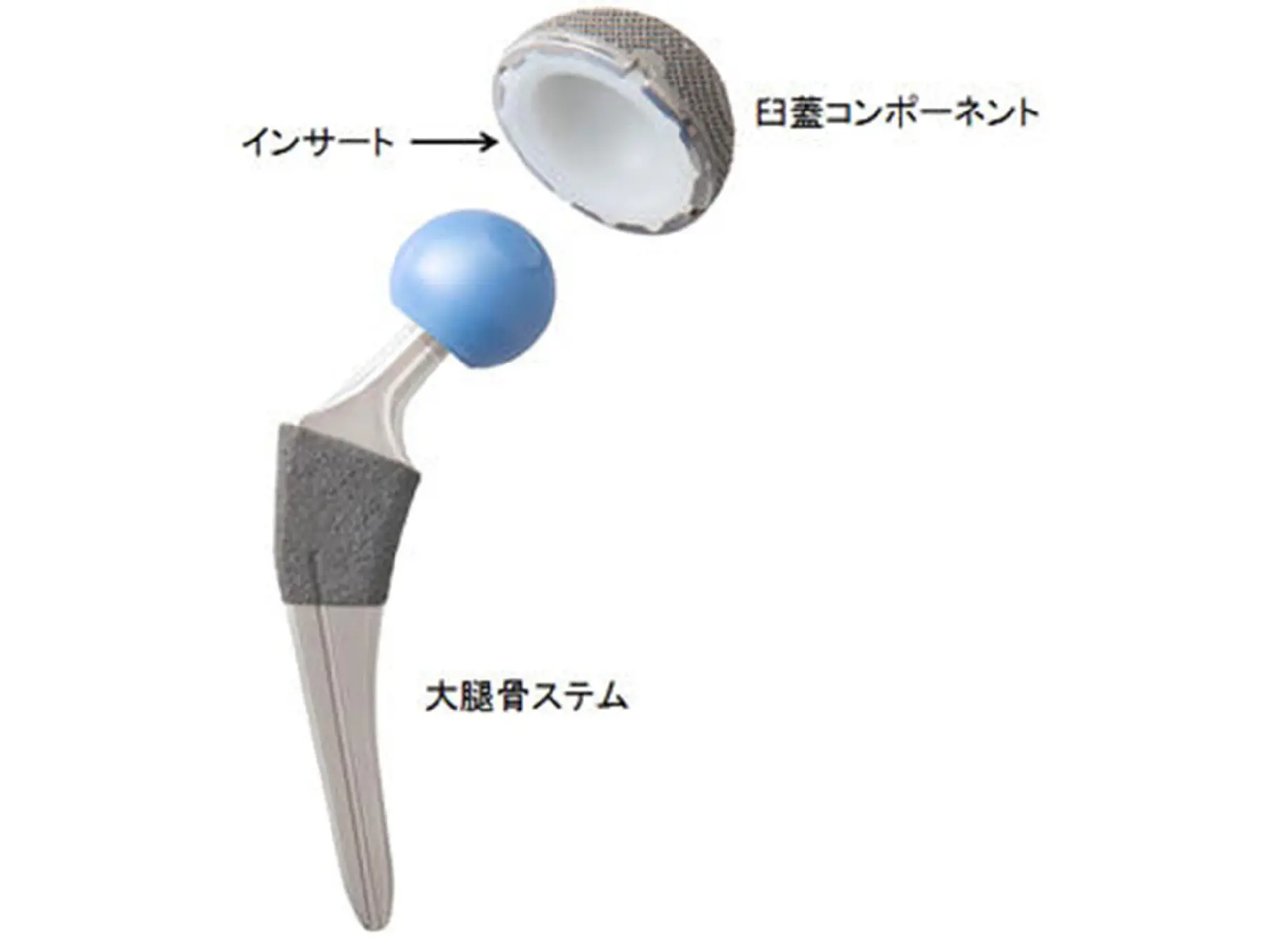 人工股関節の各部品