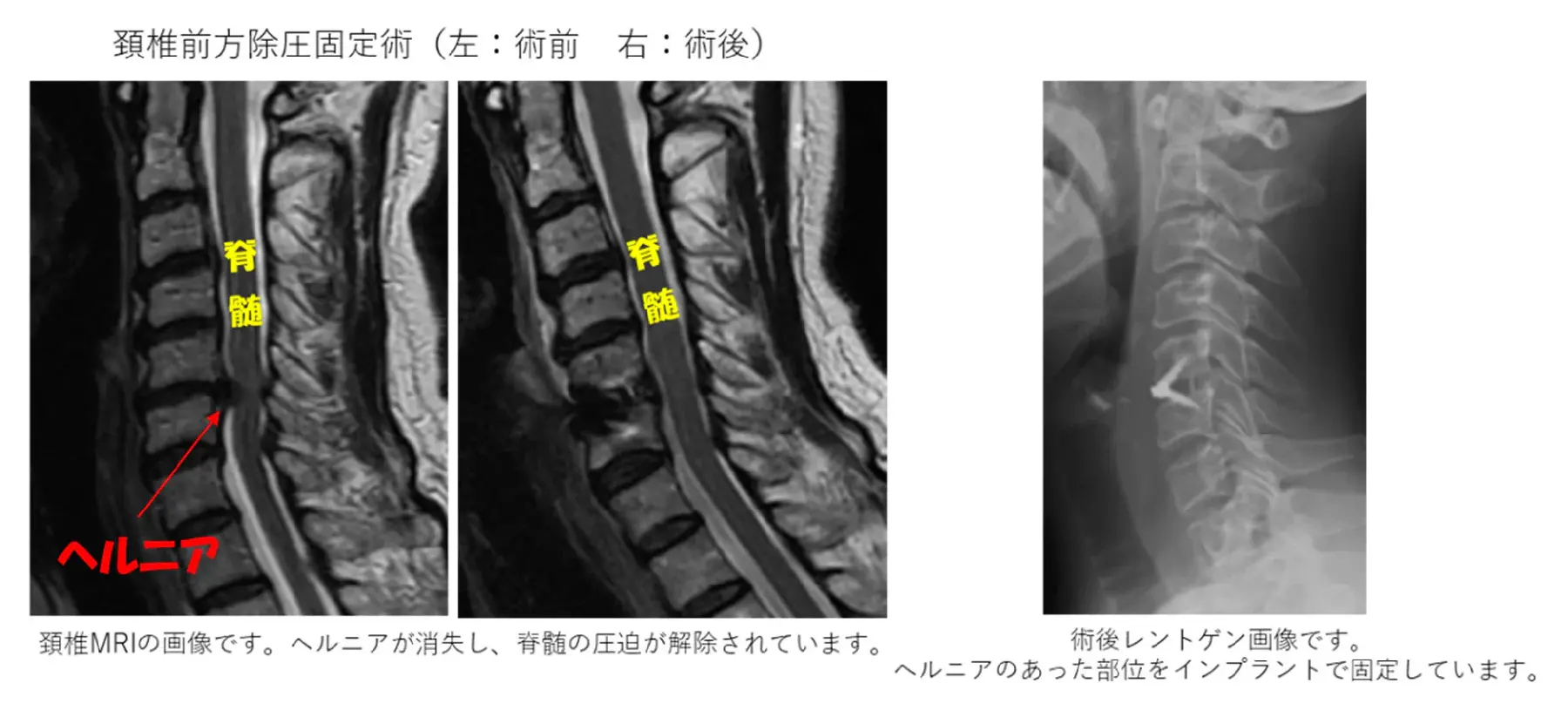 頚椎前方除圧固定術(左-術前右-術後)