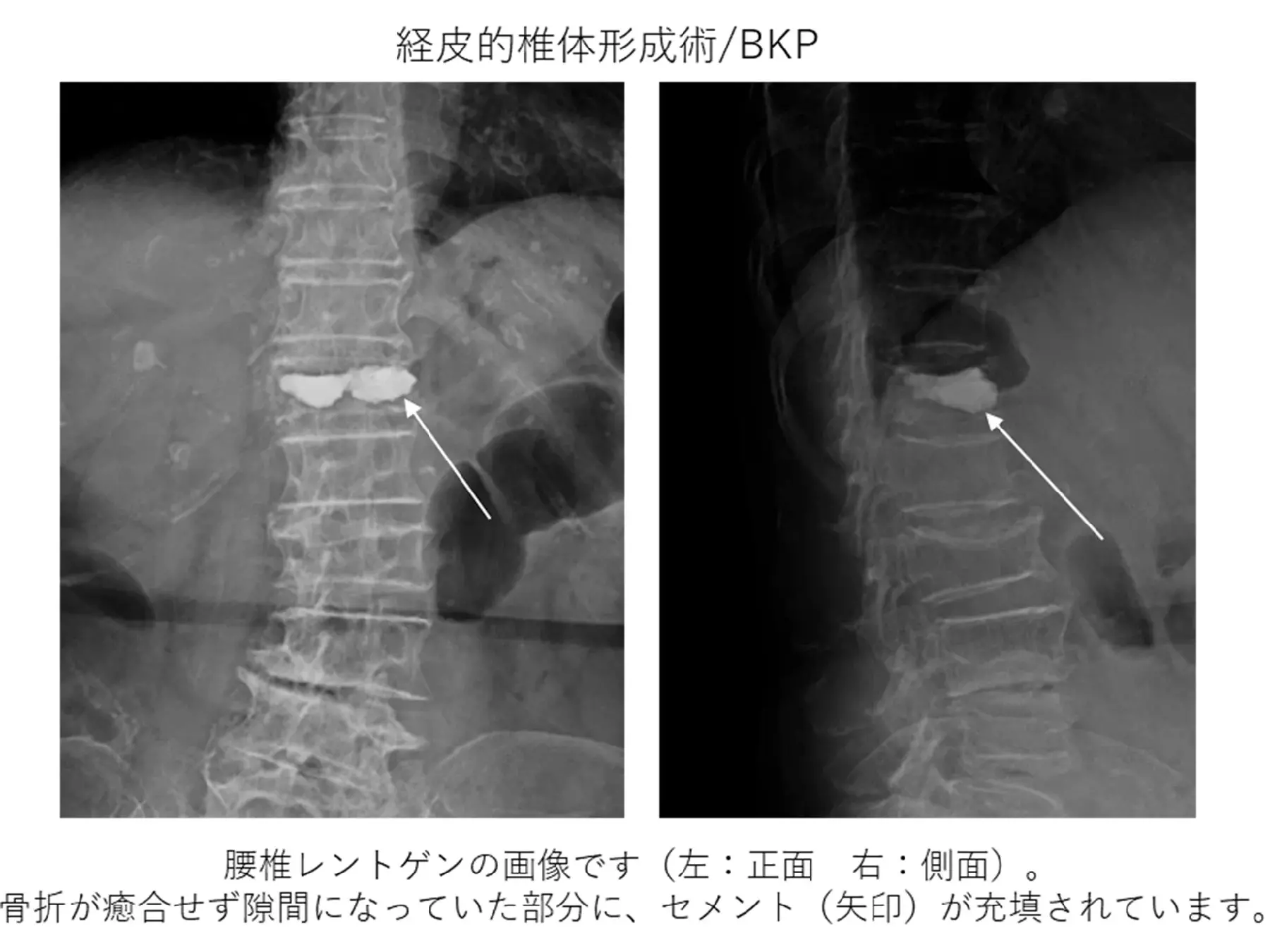 経皮的椎体形成術_BKP