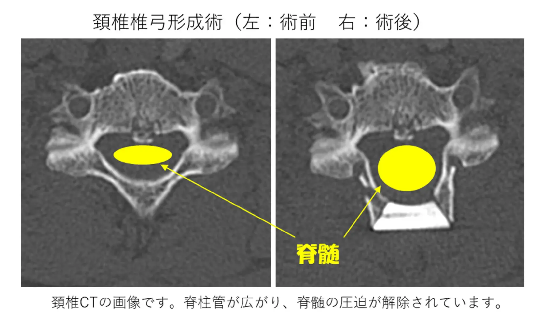 頚椎椎弓形成術(左-術前右-術後)