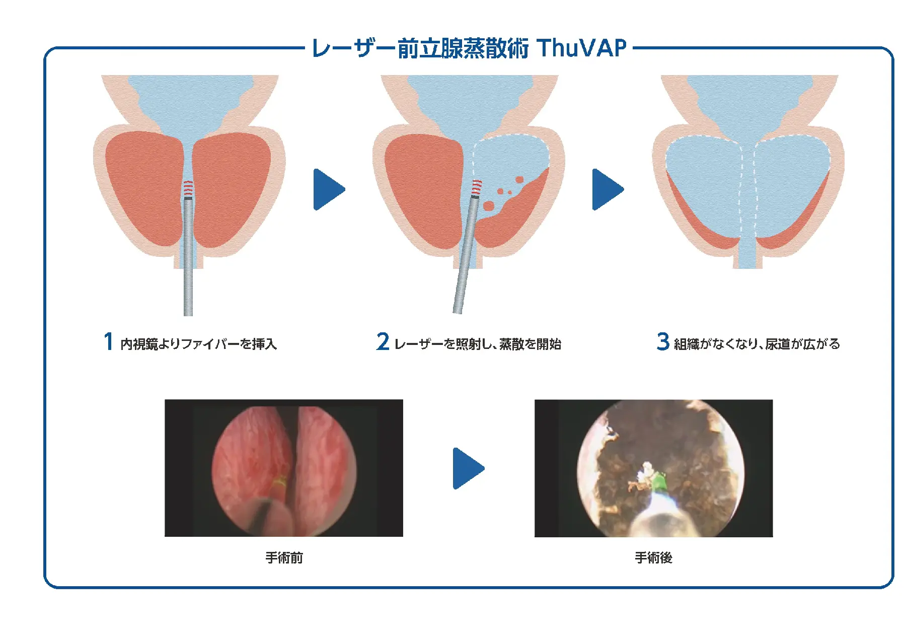 レーザー前立腺蒸散術