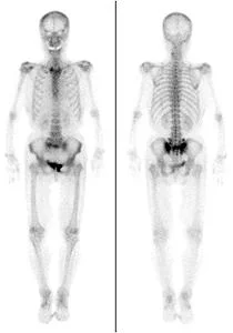 骨シンチグラフィ