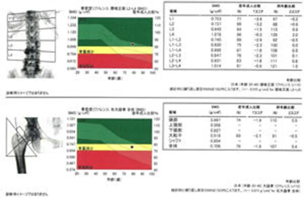 骨密度測定