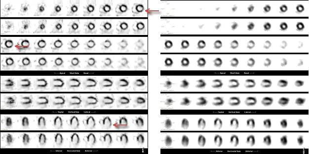 図2. D-SPECTと通常のSPECTの画質の違い