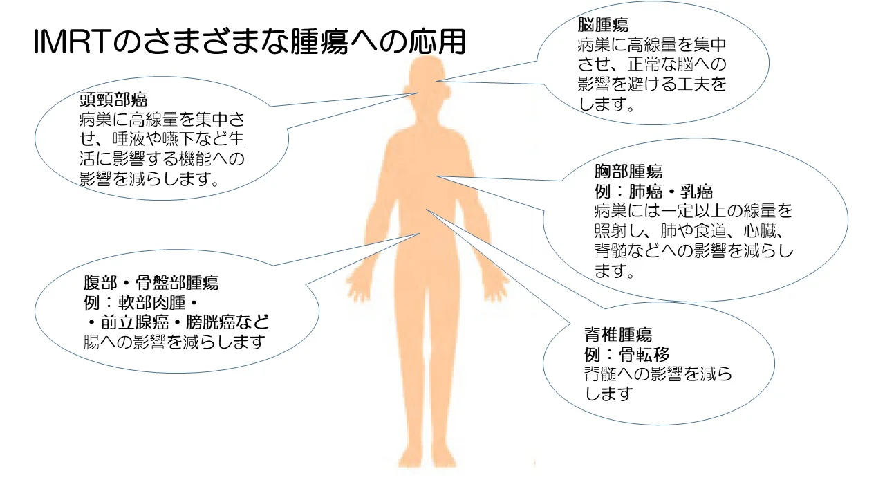 強度変調放射線治療（IMRT）
