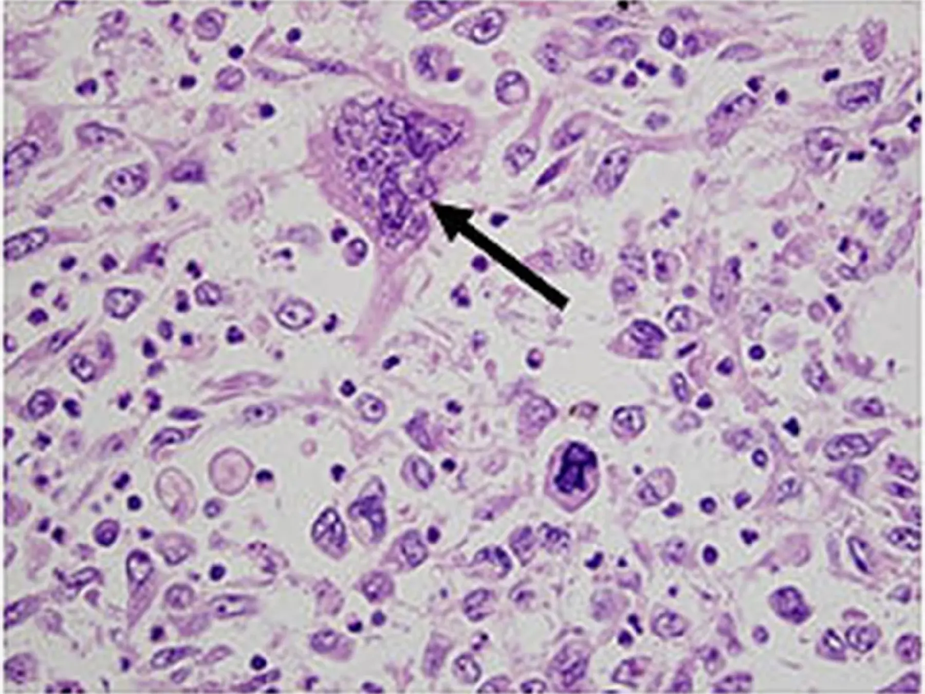 不顕性癌の病理像、Hematoxylin & Eosin染色