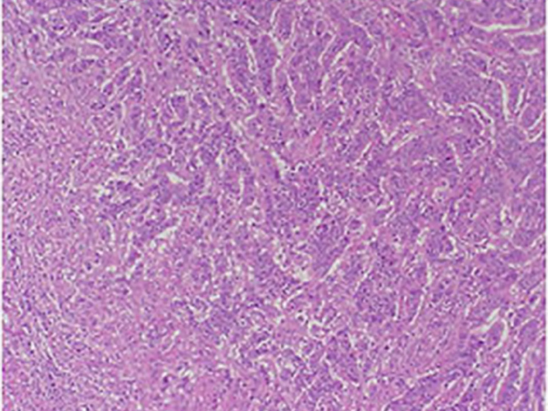 Tumor-infiltrating lymphocyt