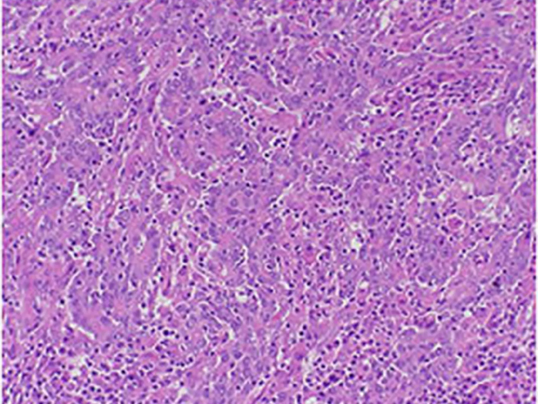 Tumor-infiltrating lymphocyt