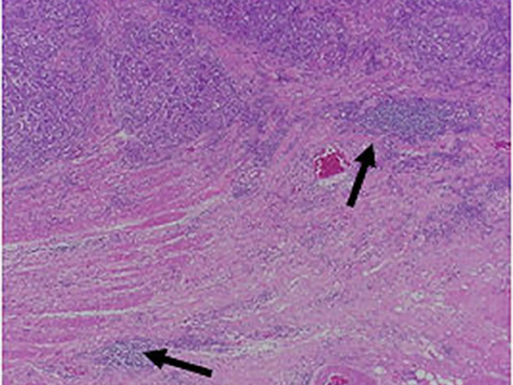 Crohns-like lymphoid reaction