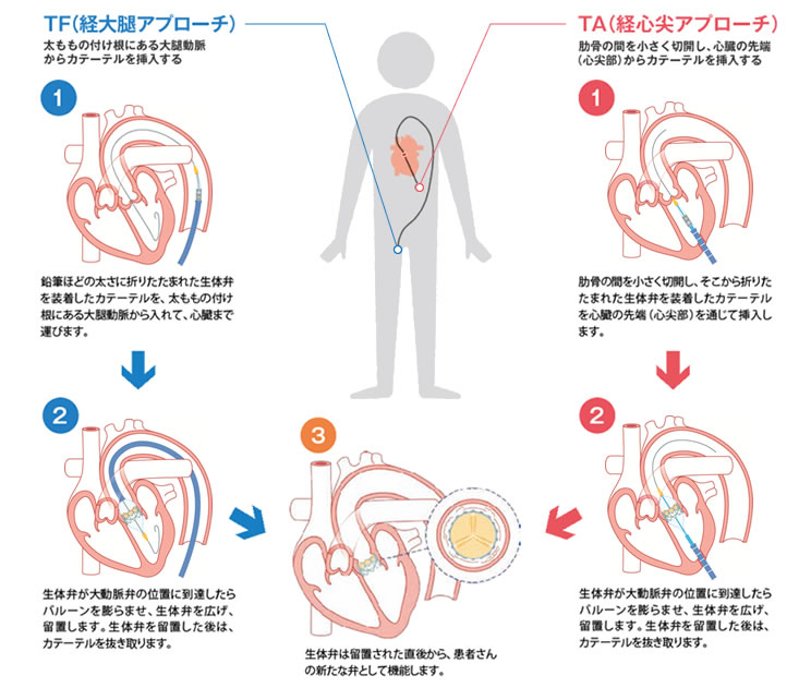 TAVI治療法