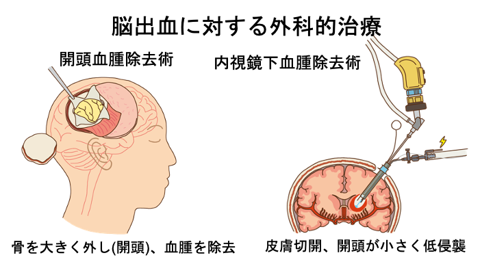 脳出血に対する外科的治療