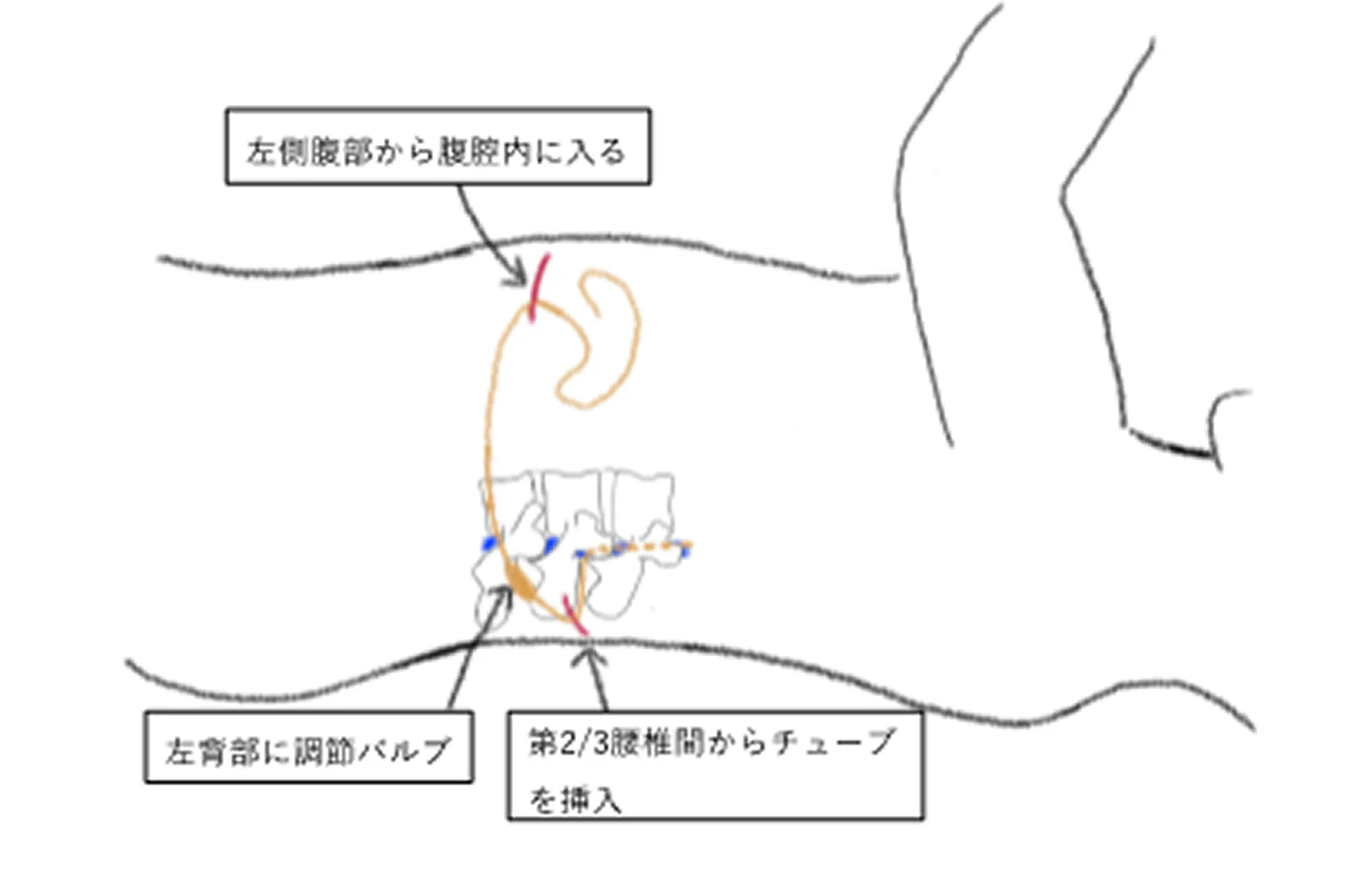 正常圧水頭症03