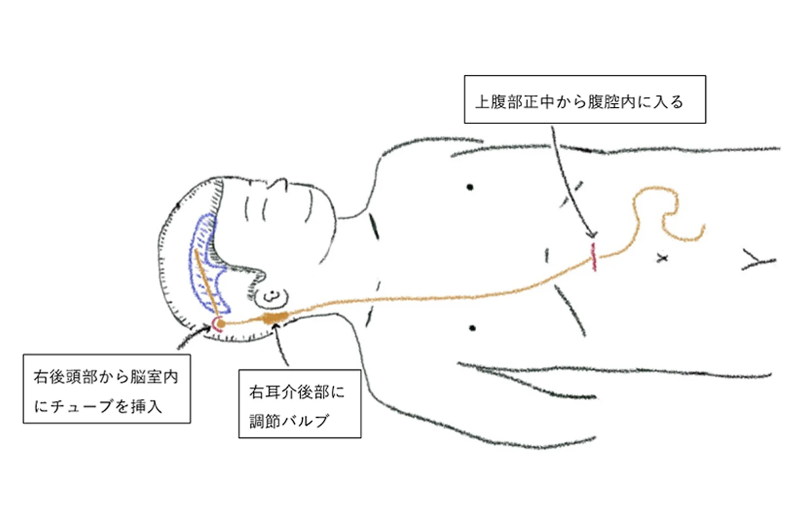 正常圧水頭症02
