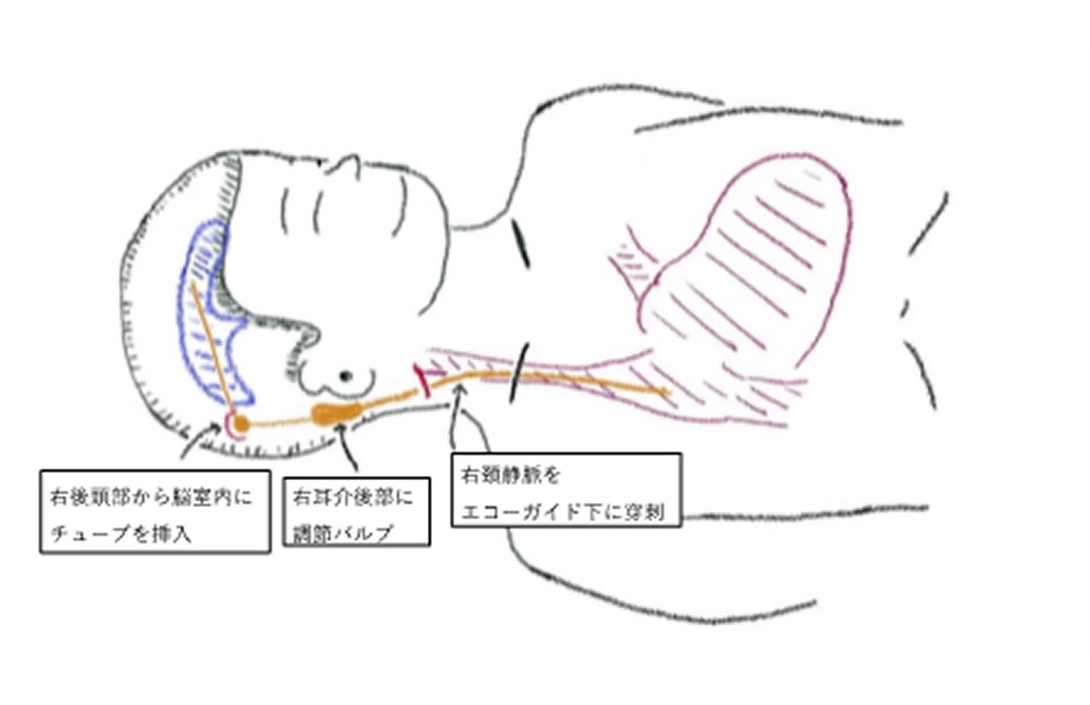 正常圧水頭症04