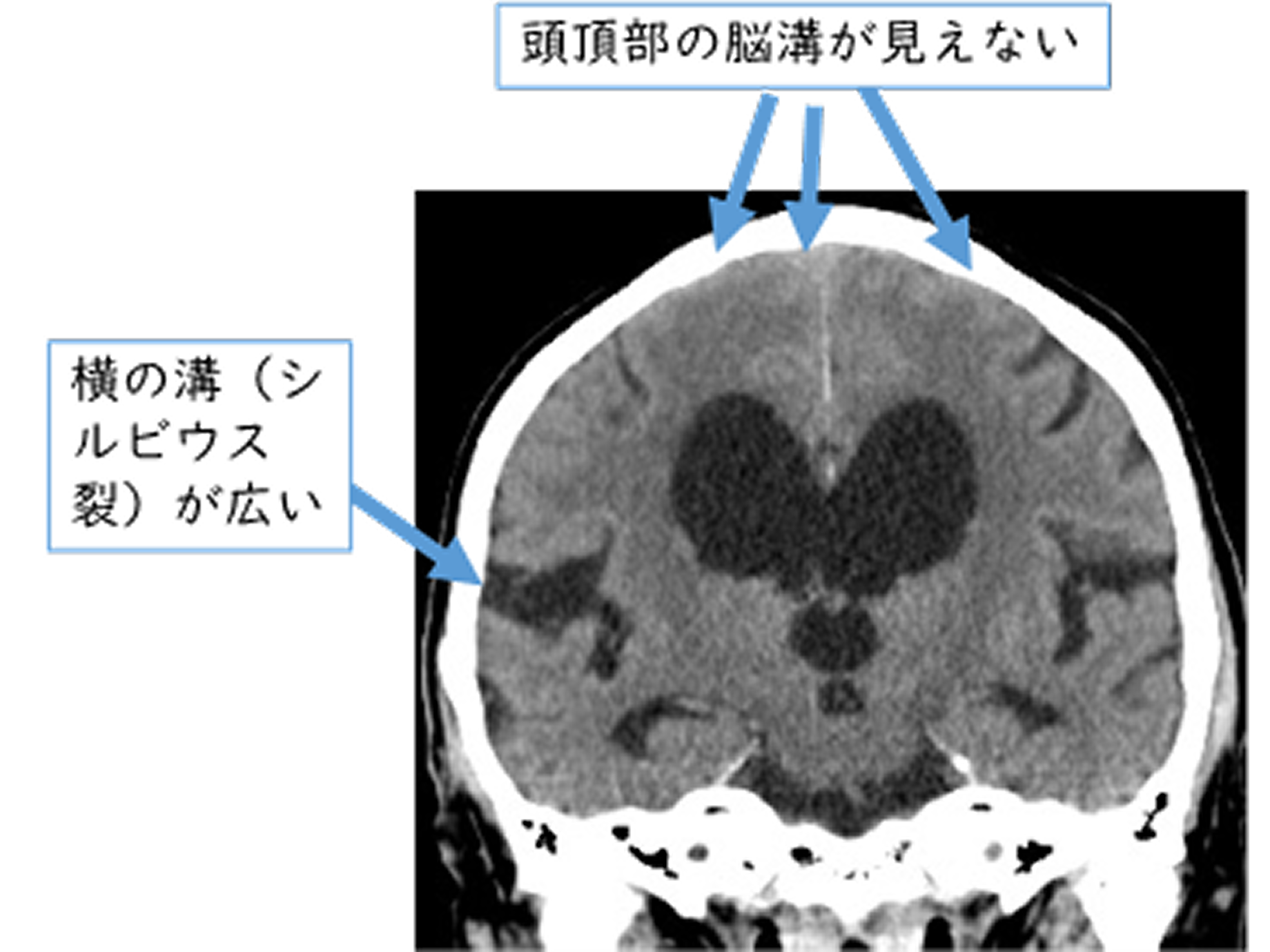 正常圧水頭症01