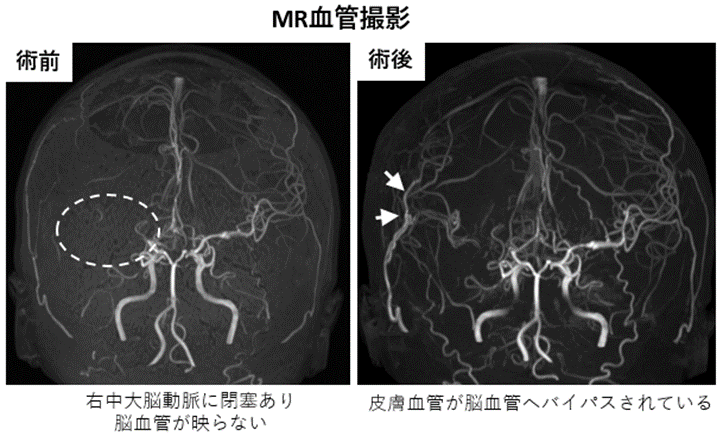 頭蓋内主幹動脈閉塞症03