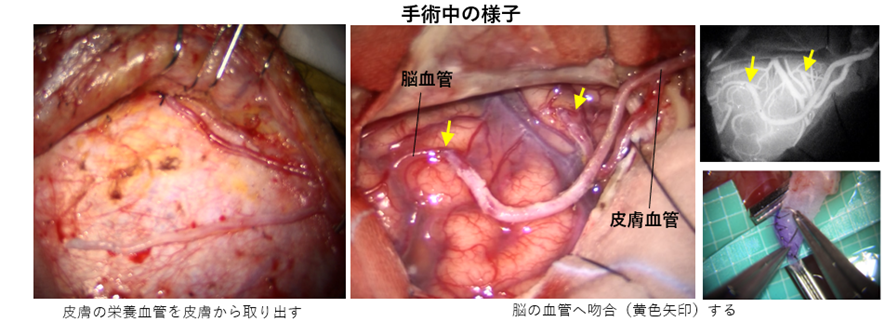 頭蓋内主幹動脈閉塞症02