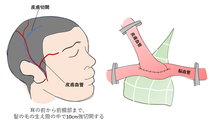 頭蓋内主幹動脈閉塞症01