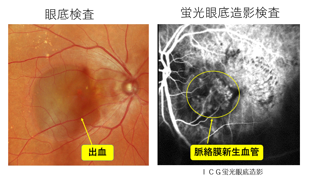加齢黄斑変性01