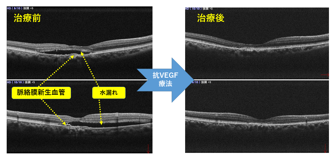 加齢黄斑変性03