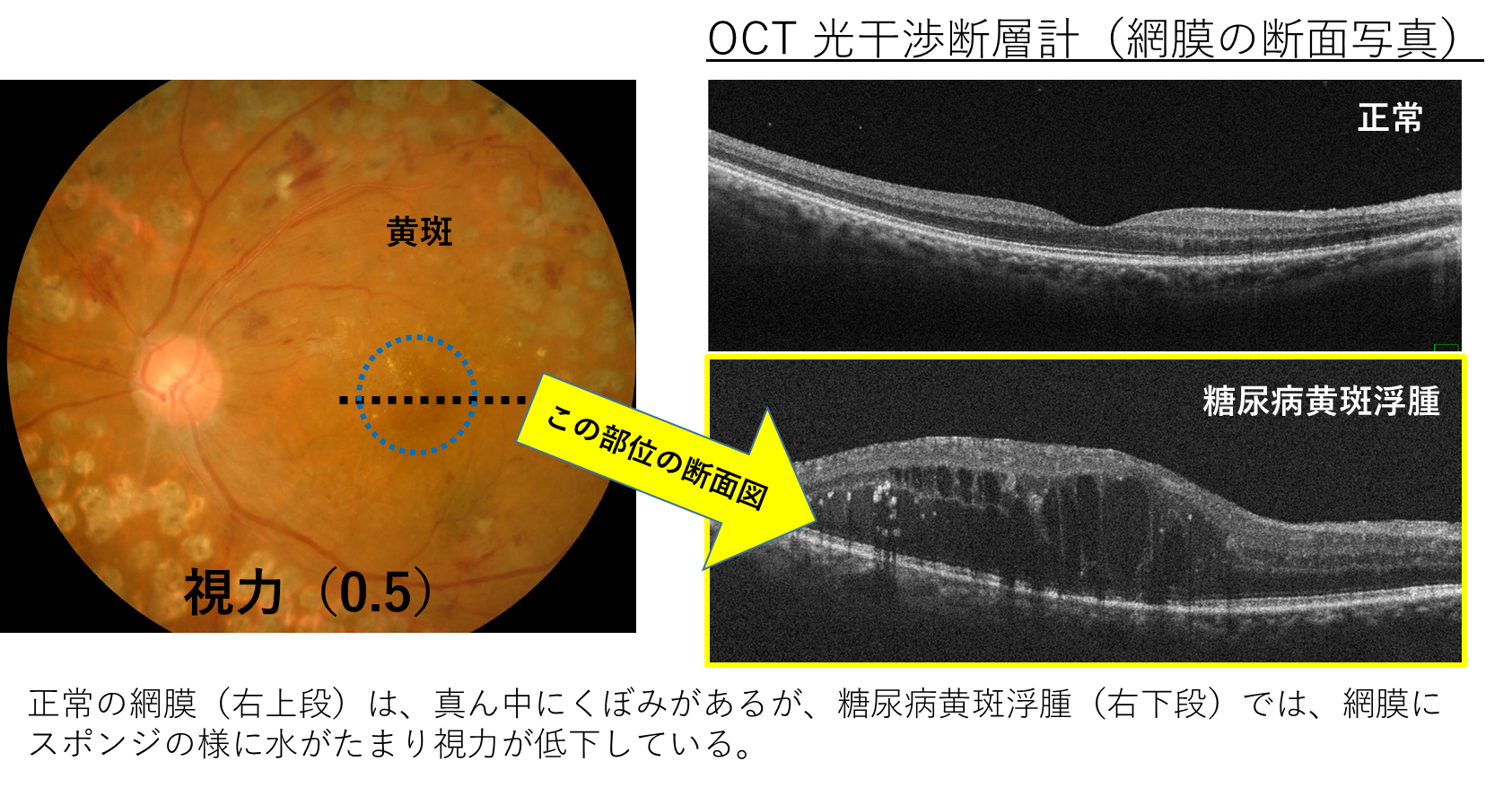 糖尿病黄斑浮腫
