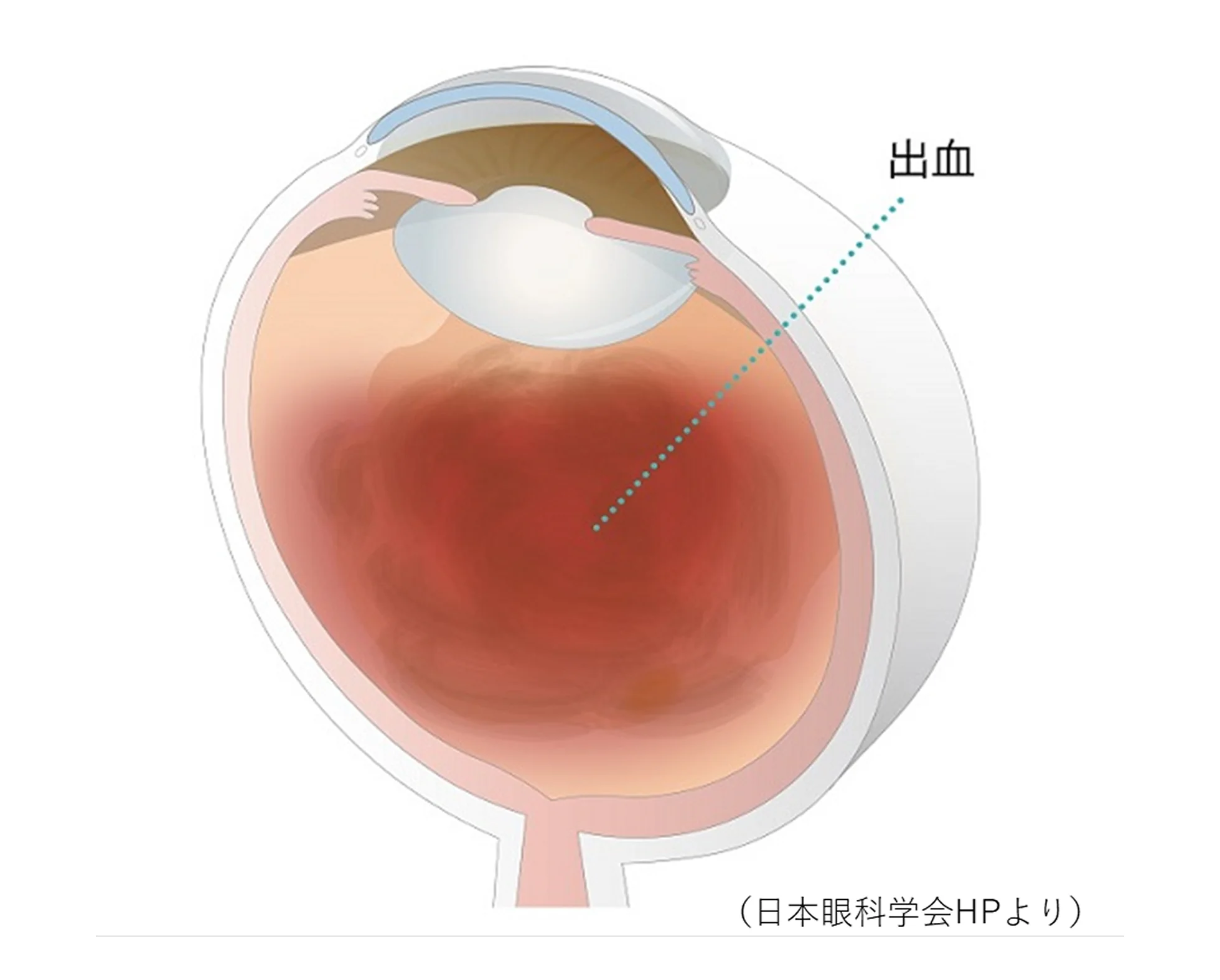 硝子体出血のイメージ　