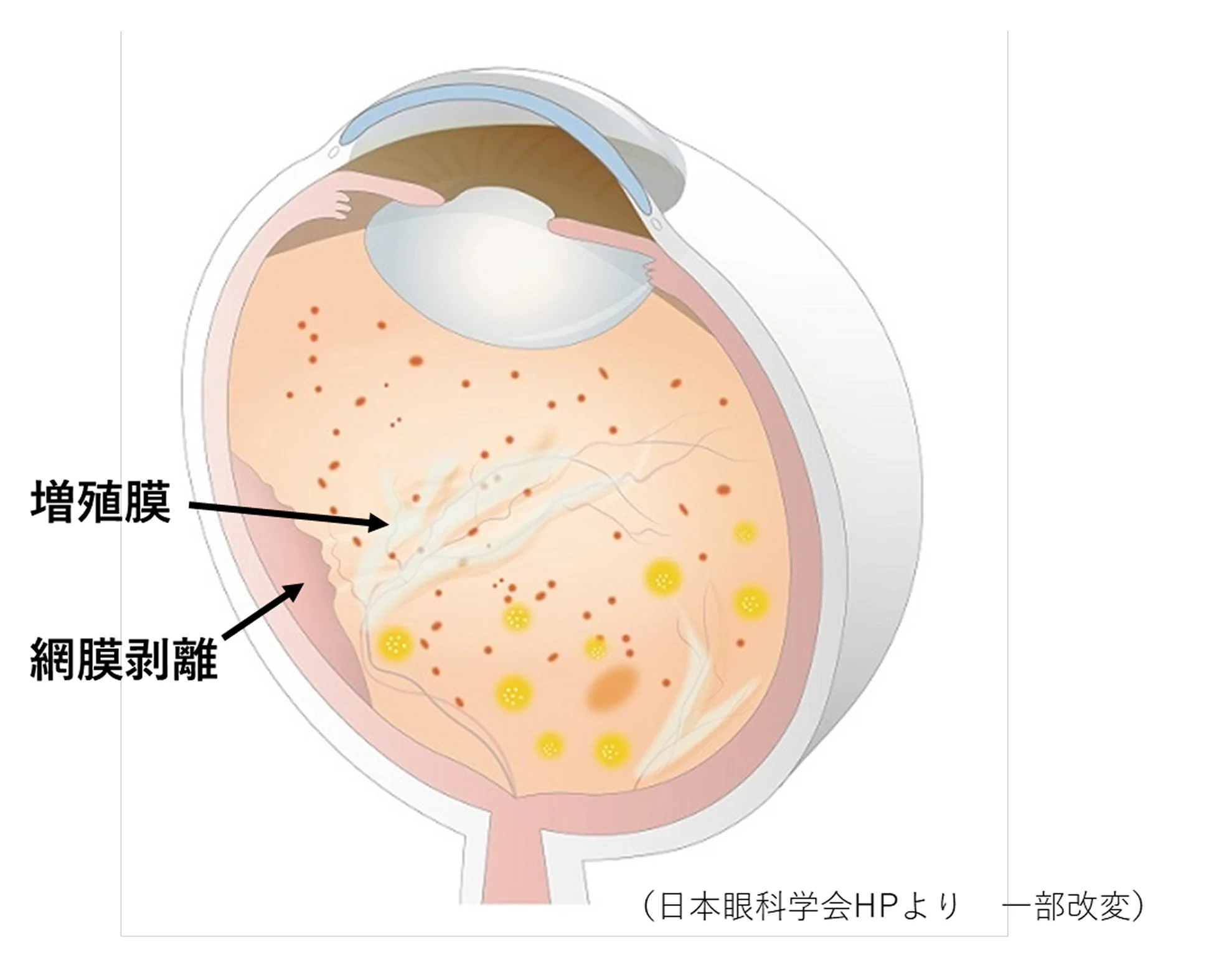 網膜剥離のイメージ