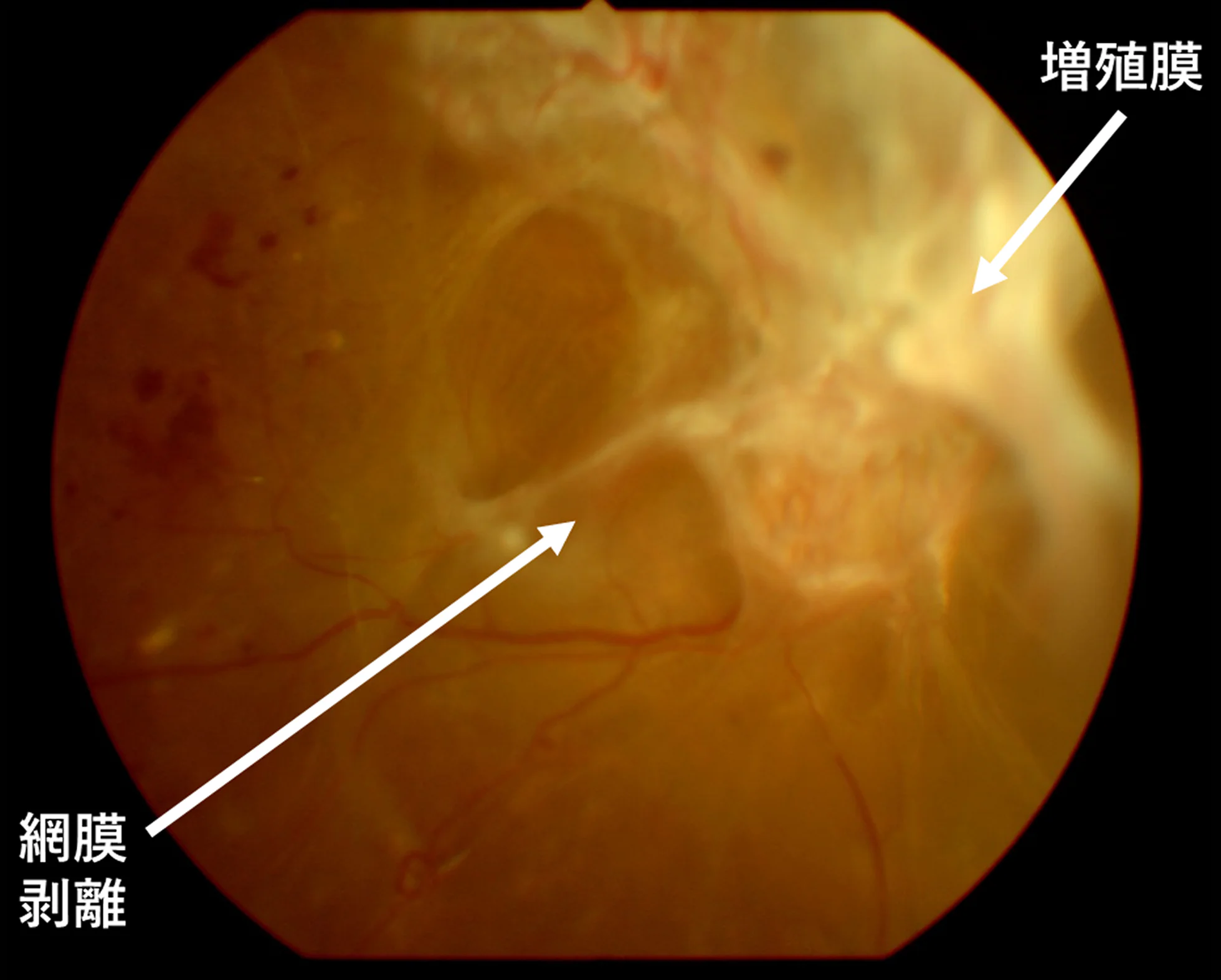 増殖膜と網膜剥離　