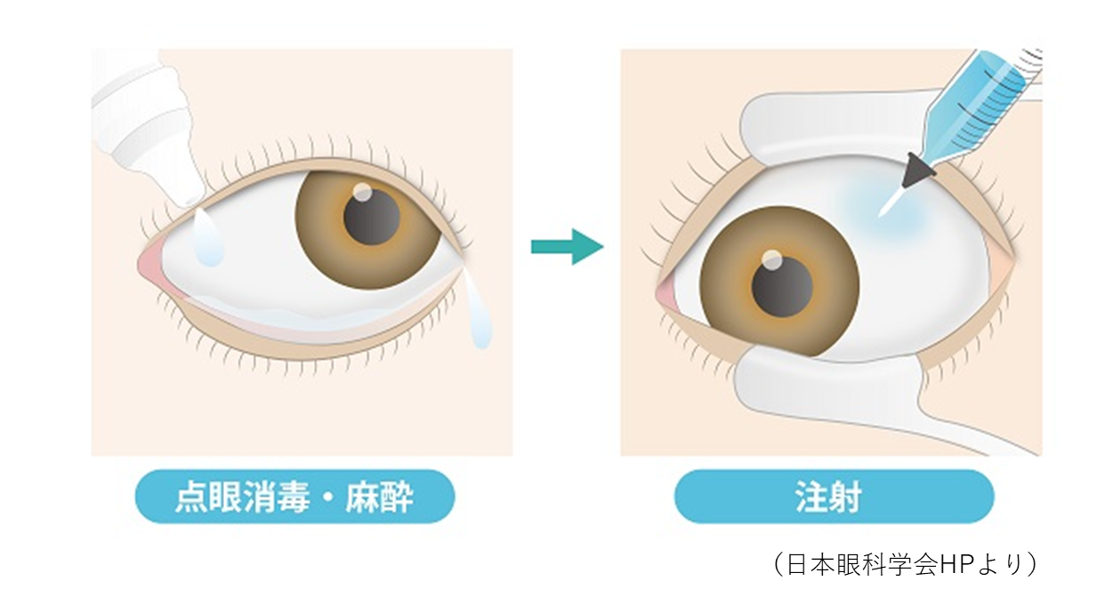 抗VGEF療法