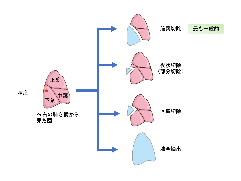 肺がんの手術(切除範囲）