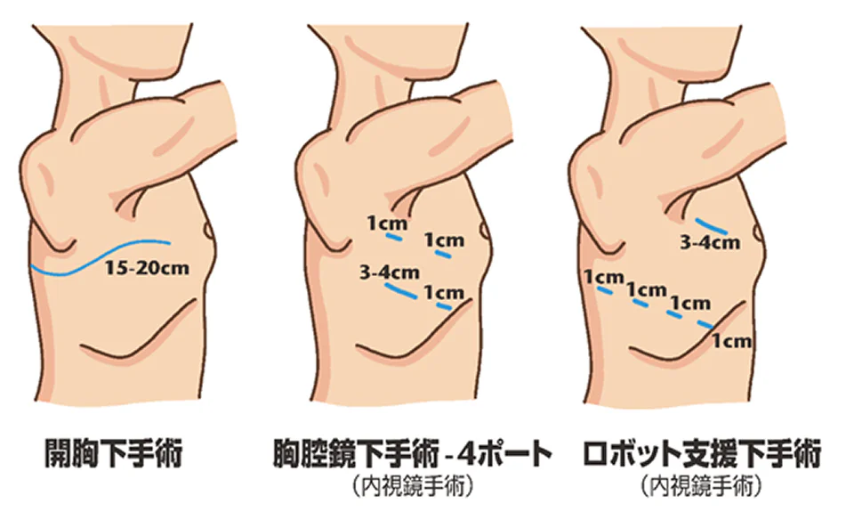 手術の創部