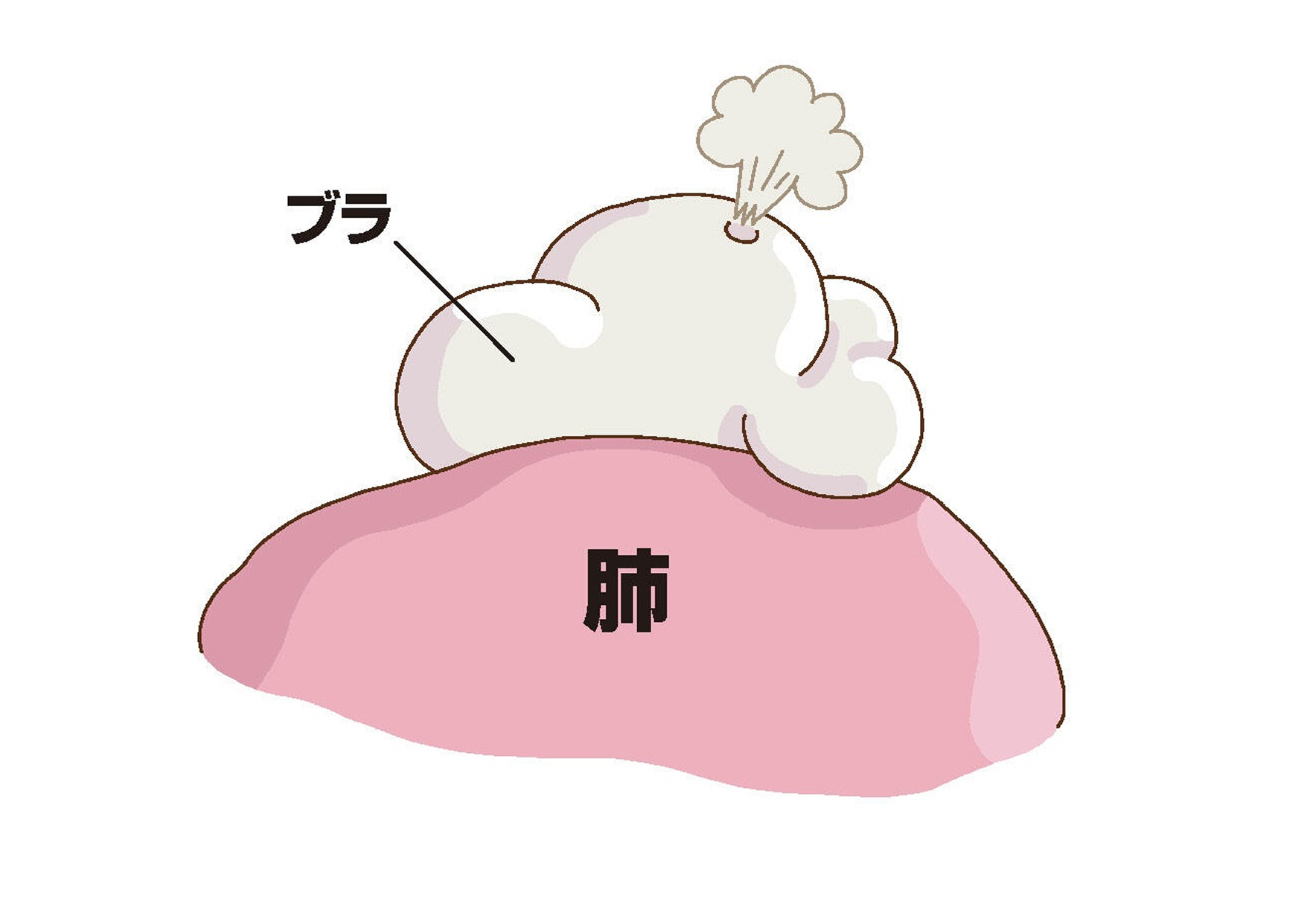気胸（ききょう）03