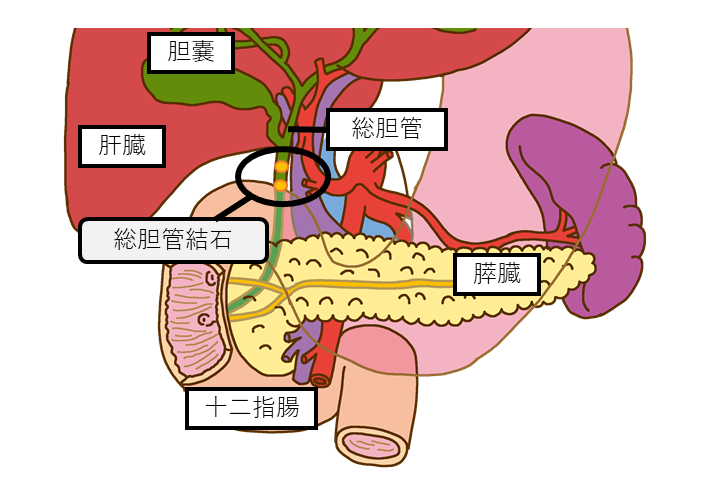 総胆管結石01