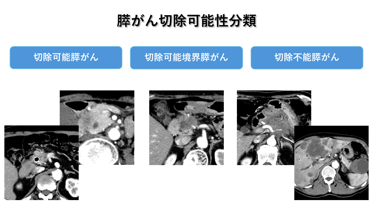 膵がん切除可能性分類