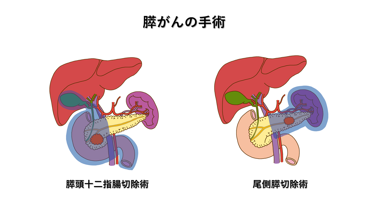 膵がんの手術